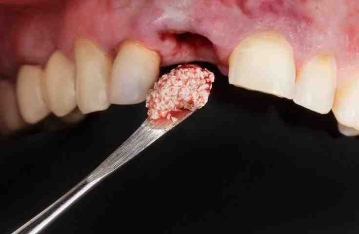 how-long-can-you-wait-to-get-a-dental-implant-after-extraction-dental