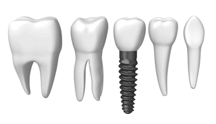 How long dental implant last