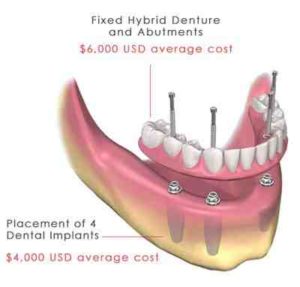 How much do all on 4 dental implants cost - Dental News Network