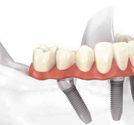 How long do all on 4 implants last?