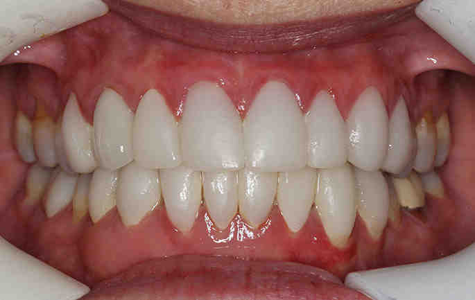 How long do crowns last on front teeth?