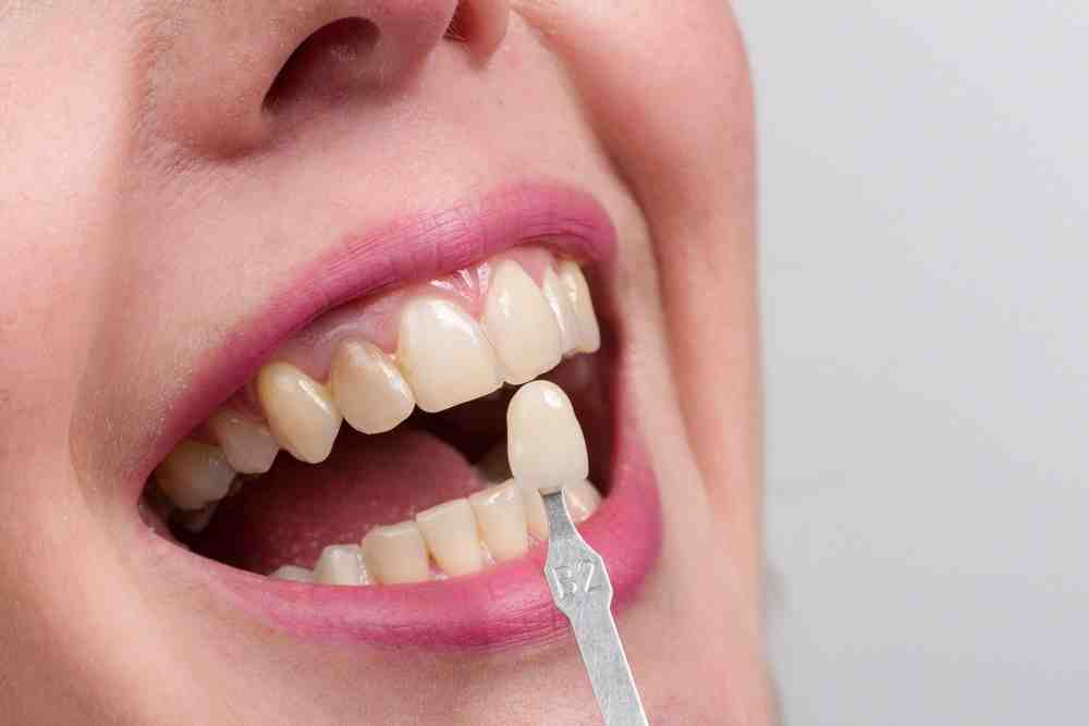 How long do dental implants last?