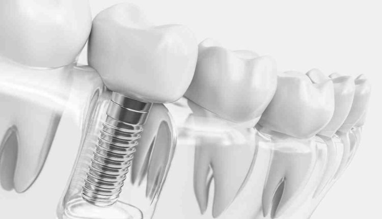 How long do dental implants last today