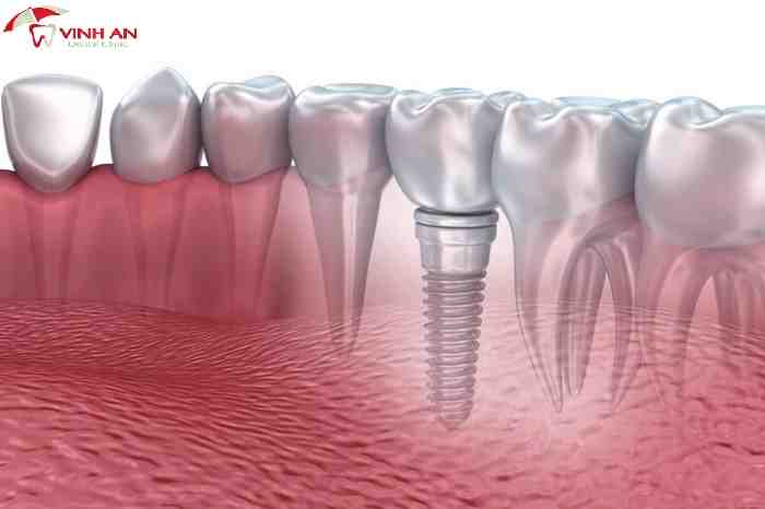 How long do dental implants last?