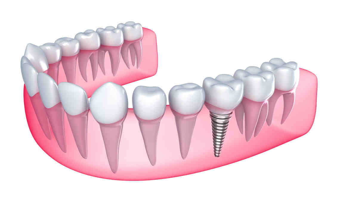 How long do dental implants take to fit?