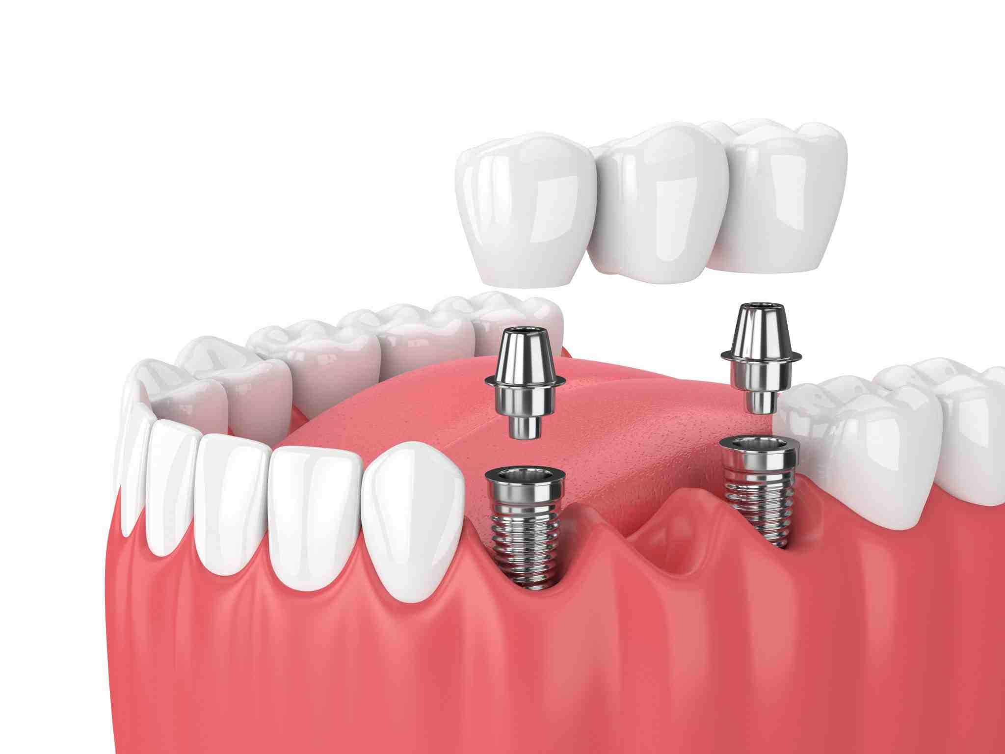 How long do mini dental implants last?