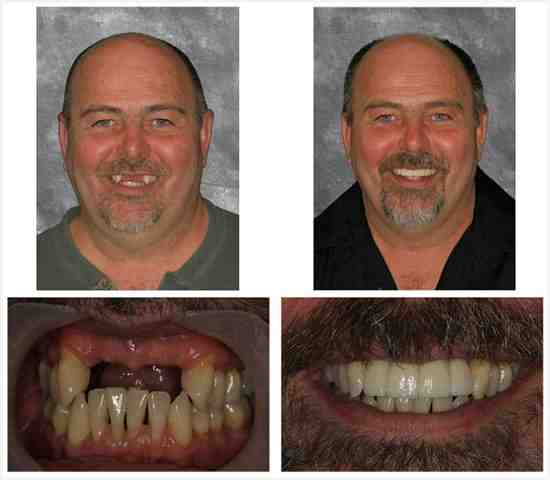 How long do mini dental implants last?