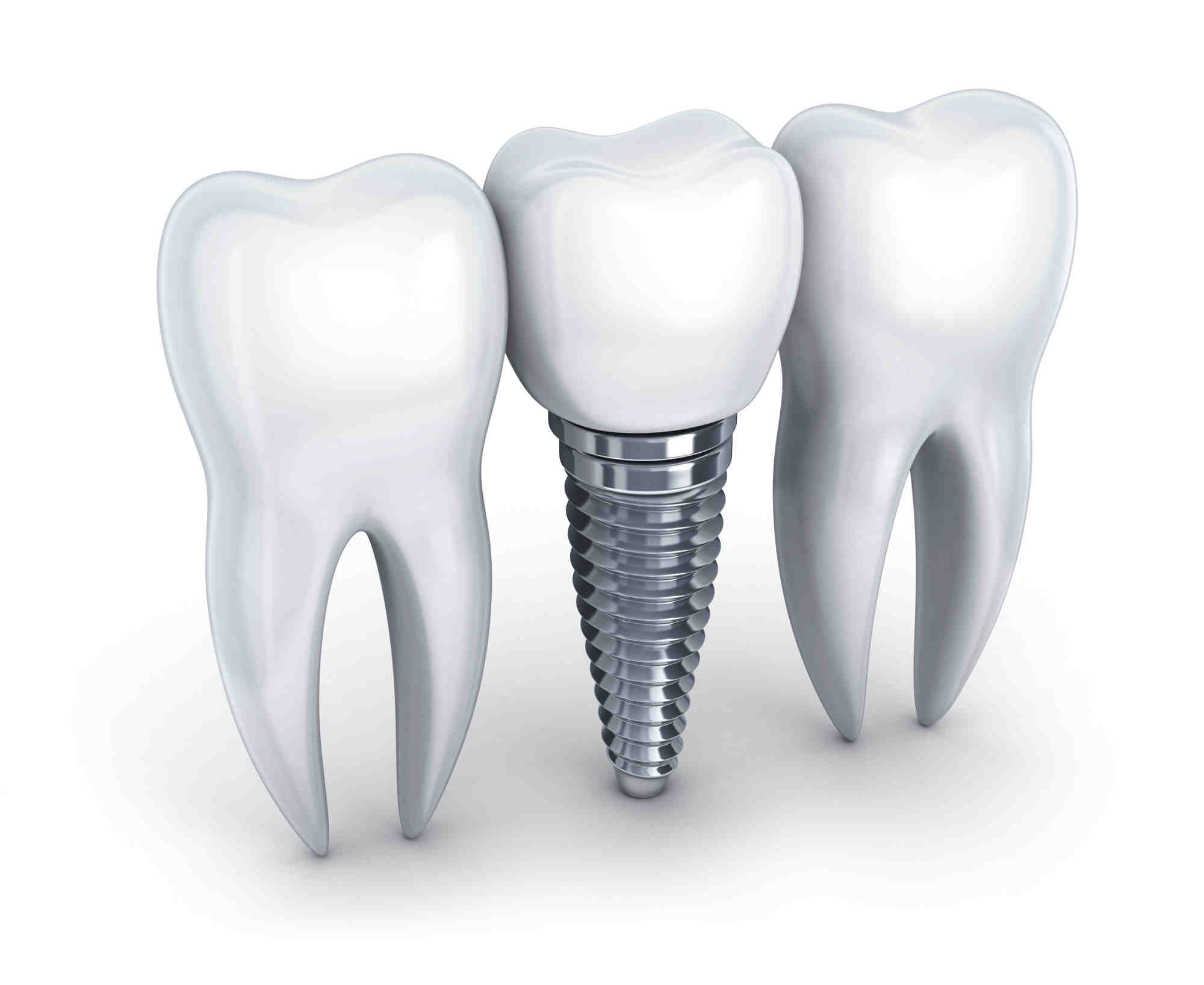 How long does a dental implant procedure take?