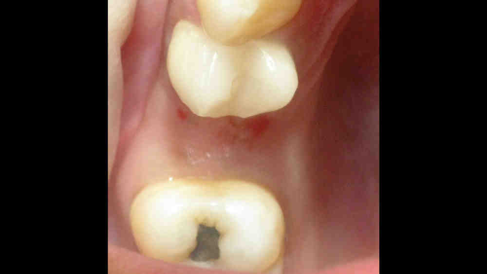 How long does a dental implant procedure take?