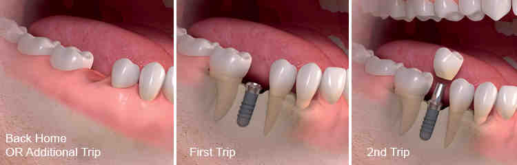 How long does an implant take from start to finish?