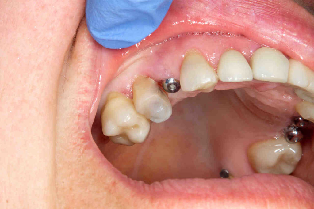 How Long Does Swelling Last After Dental Implant Dental News Network 