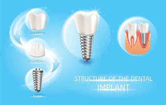 How long does it take to get a dental implant put in?