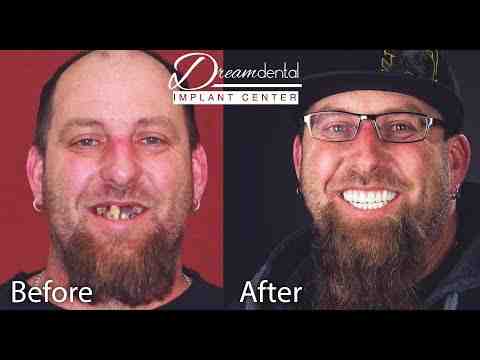 How long does it take to get full mouth dental implants?