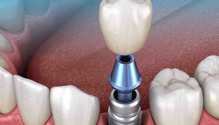 How long for mini dental implant pain to stop