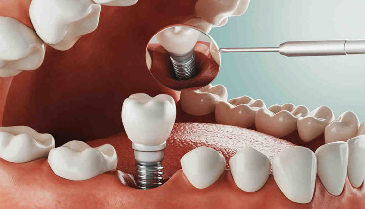 How long have dental implants been around