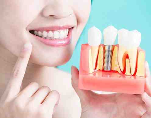 How long have dentists been doing implants?