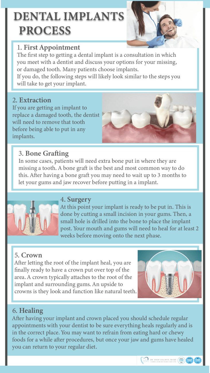 What are the steps in getting a dental implant Dental News Network