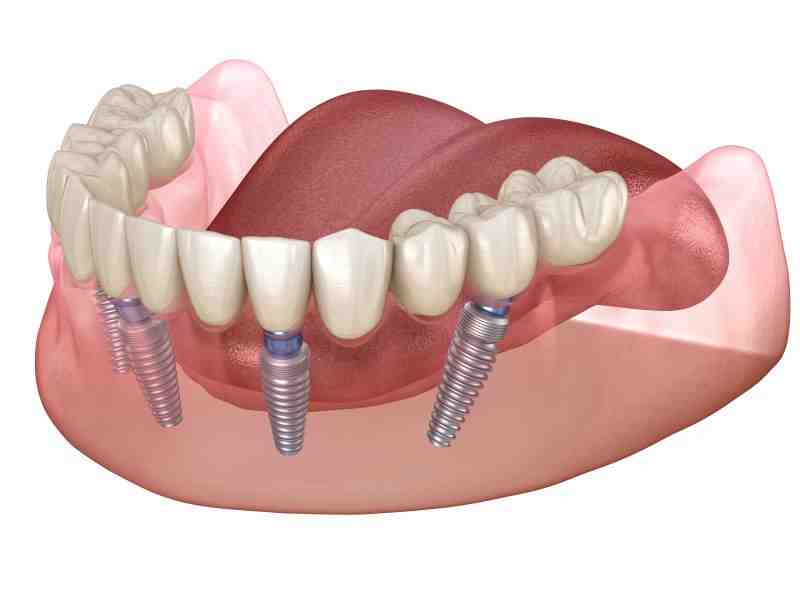 How many implants are needed for full mouth?