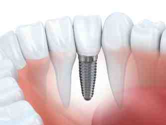 How many teeth can be implanted at once?
