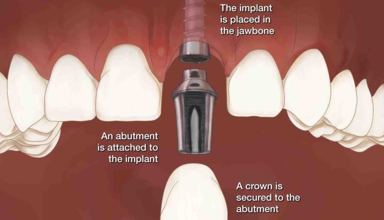 How much a dental implant cost