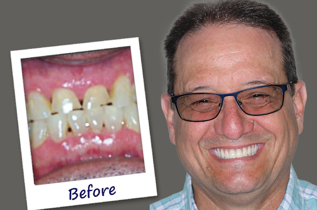 How much are dental implants at clear choice
