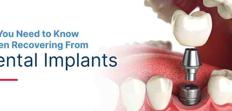 How much did you pay for dental implants