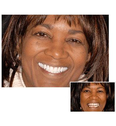 How much do clearchoice dental implants cost
