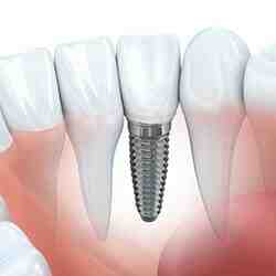 How much do dental implants cost in 2020?
