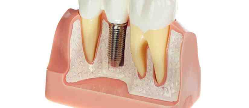 How much do dental implants cost in Arizona?