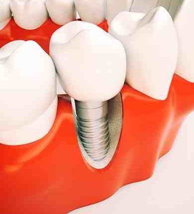 How much do dental implants cost in ohio