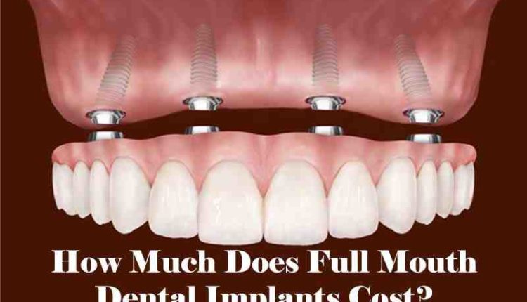 How much do full mouth dental implants cost