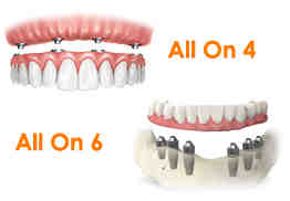 How much do full upper and lower dental implants cost?