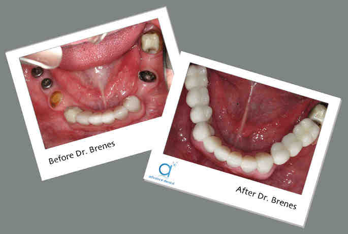 How much does 4 teeth implants cost?