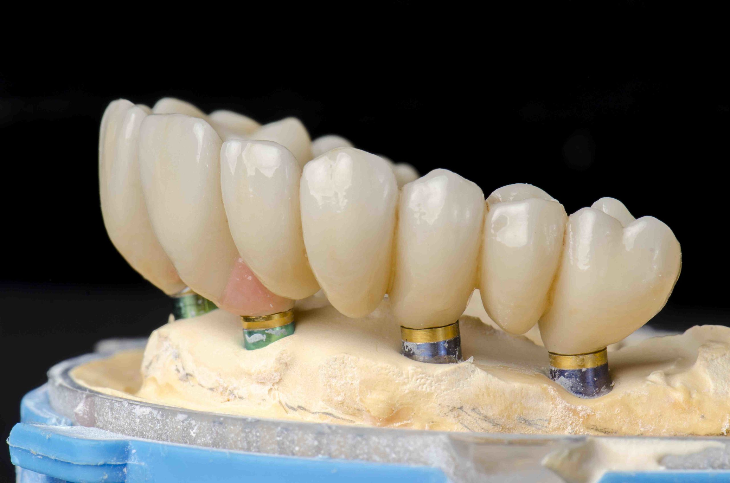 How much does a 4 in 1 dental implant cost?