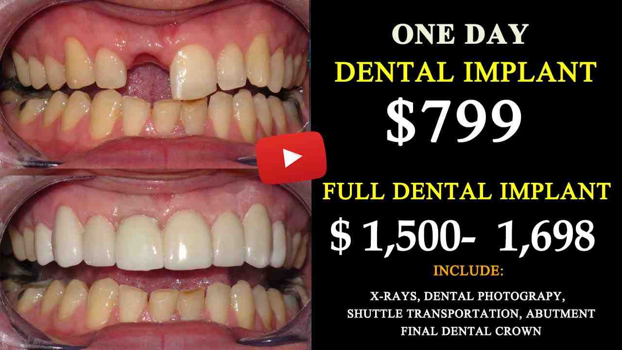 How much does a single dental implant cost - Dental News Network