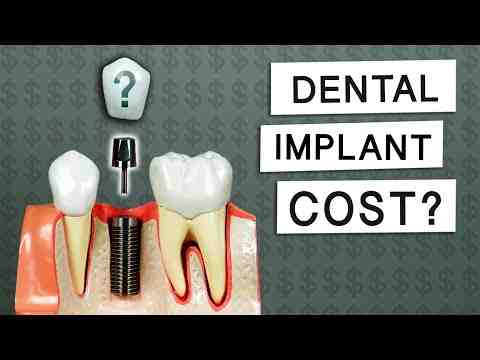 How much does a dental implant cost for one tooth?