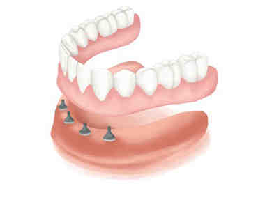 How much does a dental implant cost for one tooth?