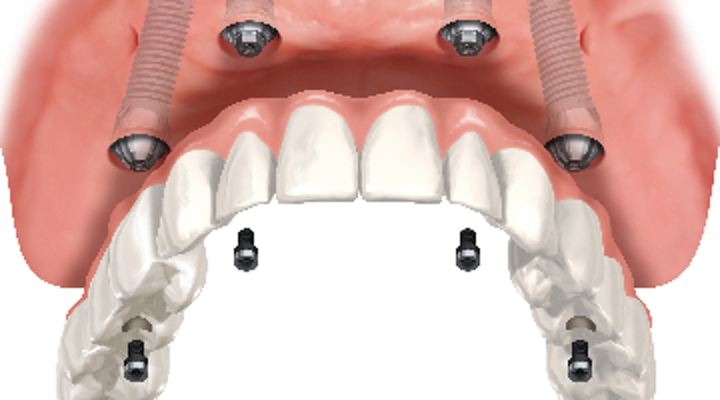 How much does a dental implant cost for one tooth?