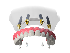 How much does a full set of dental implants cost?