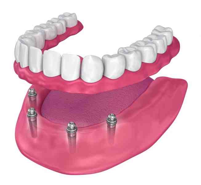 How much does a full set of teeth implants cost?