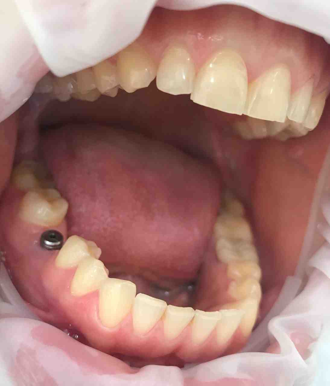 How much does a tooth implant cost in Israel?