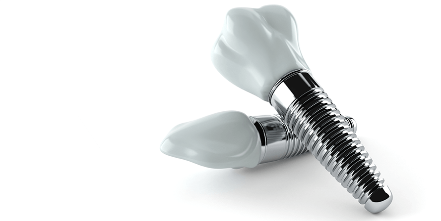 Do dental insurance cover implants Dental News Network