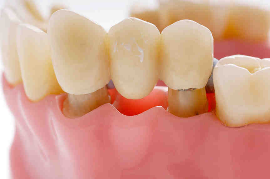 How much does it cost for two teeth implants?
