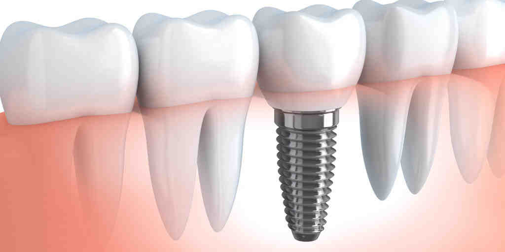 How much does it cost to get a full mouth of dental implants Ohio?
