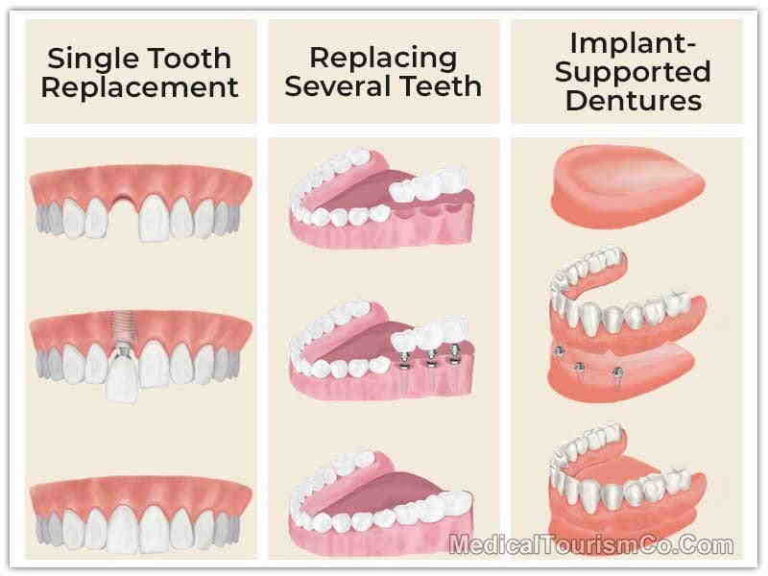 How much does it cost to get a full set of dental implants Dental