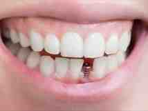 How much does it cost to get a full mouth of dental implants in Missouri?