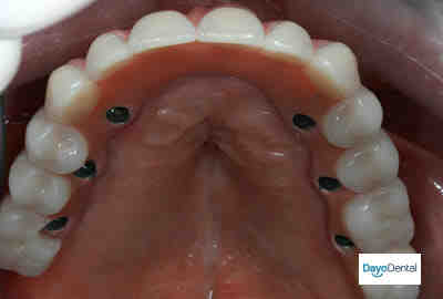 How much do full mouth dental implants cost - Dental News Network