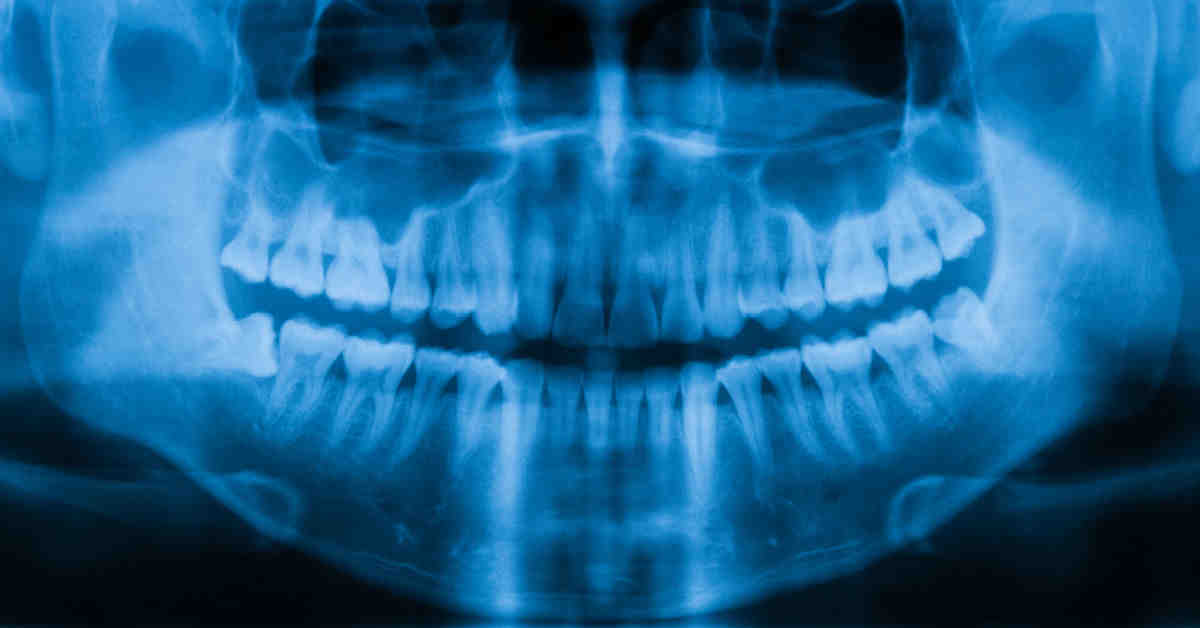 How much is a bone graft for an implant?
