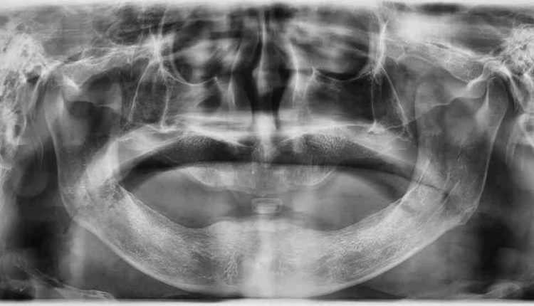 How much is a bone graft for dental implant