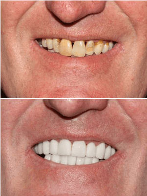 How much is a cosmetic filling?